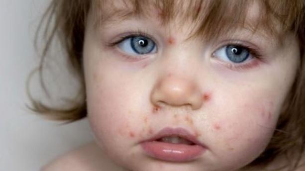 Comment se débarrasser de la varicelle chez l’enfant ?